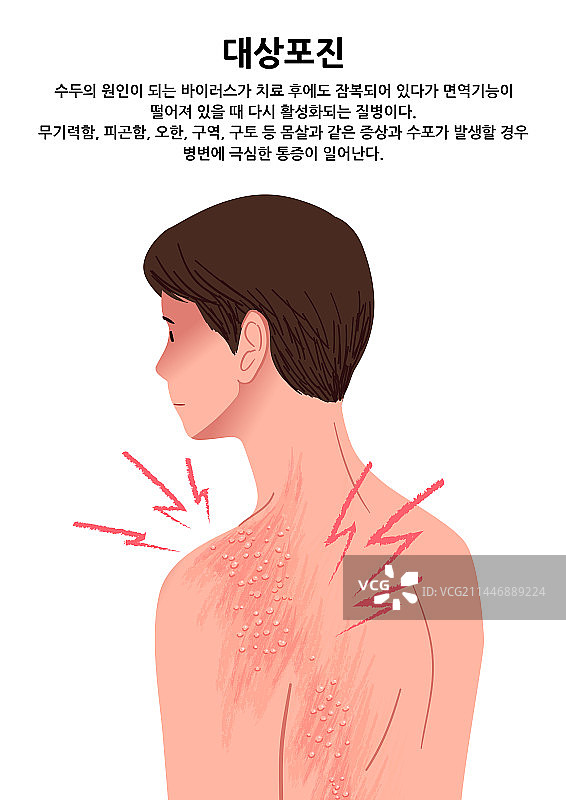 皮炎、皮肤问题、压力、疾病、带状疱疹图片素材