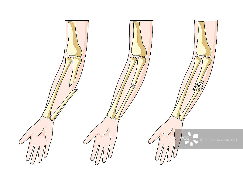 骨折图医学图片素材