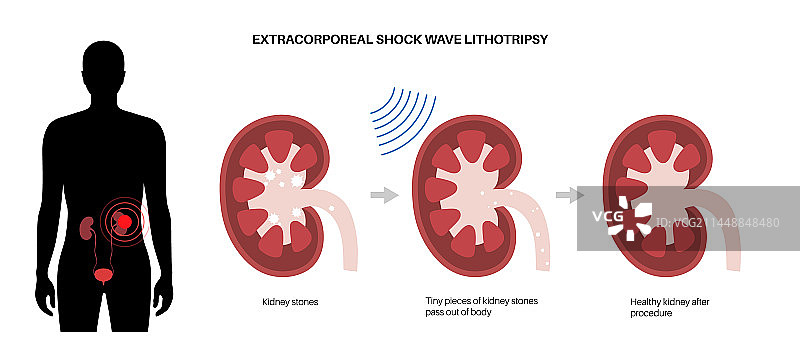 碎石术概念图片素材