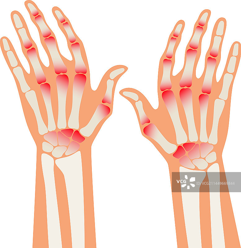 人体类风湿性关节炎手部疼痛图片素材