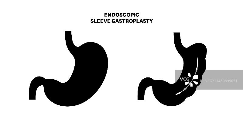 内窥镜袖状胃成形术图片素材