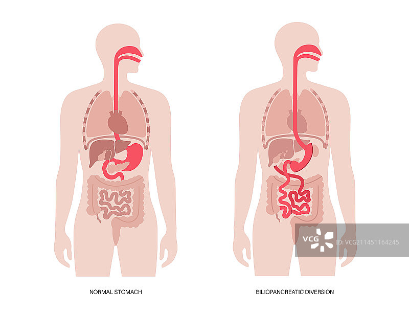 胆胰转流术图片素材