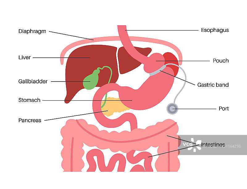 胃束带海报图片素材