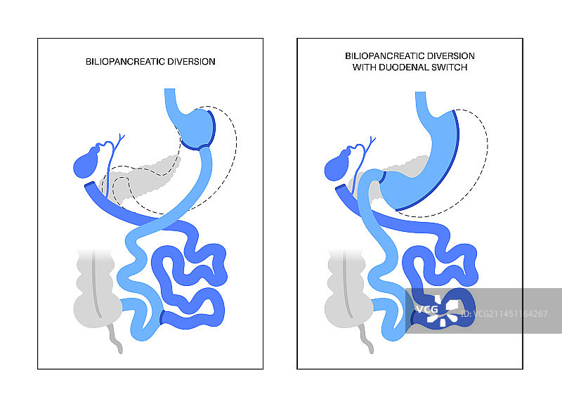 胆胰转流术图片素材