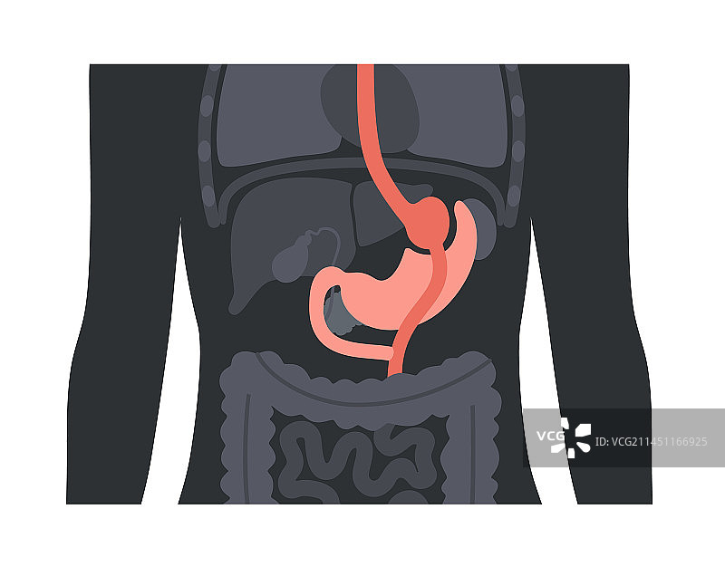 胃旁路手术图片素材