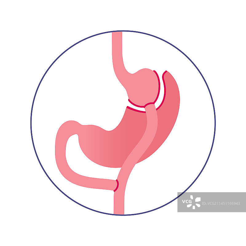 胃旁路手术图片素材