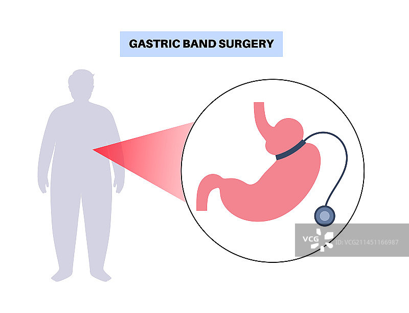 胃束带海报图片素材