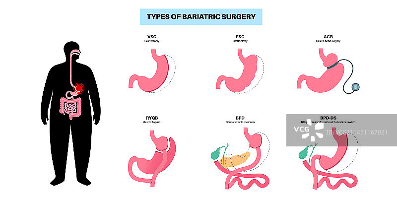 减肥手术海报图片素材