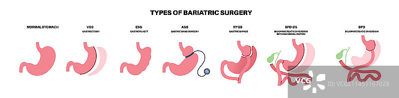 减肥手术海报图片素材
