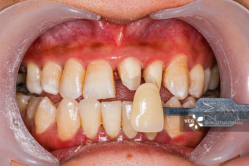 牙齿 牙冠特写图片素材