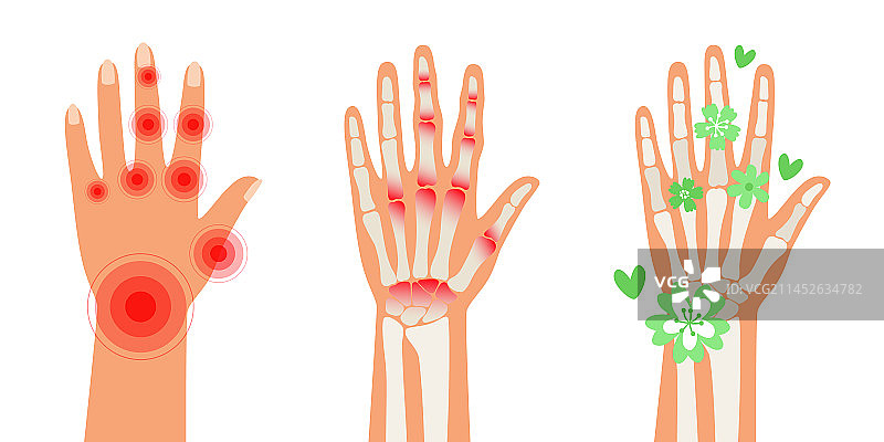 人体类风湿性关节炎手部疼痛图片素材