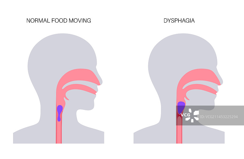 吞咽困难的医疗海报图片素材
