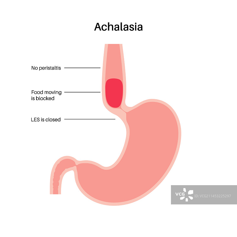 食管贲门失弛缓症图片素材