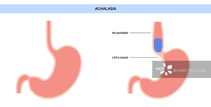 食管贲门失弛缓症图片素材
