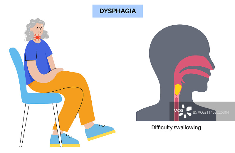 食管贲门失弛缓症图片素材