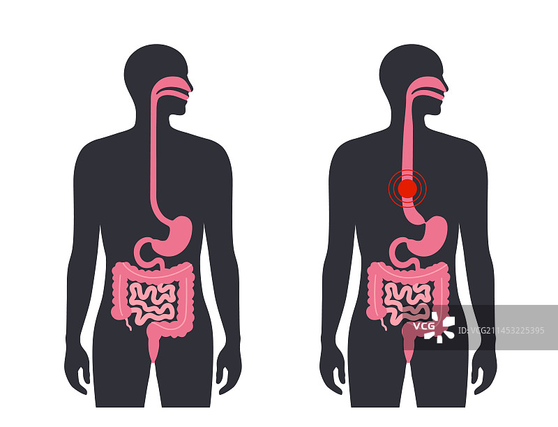 食管贲门失弛缓症图片素材