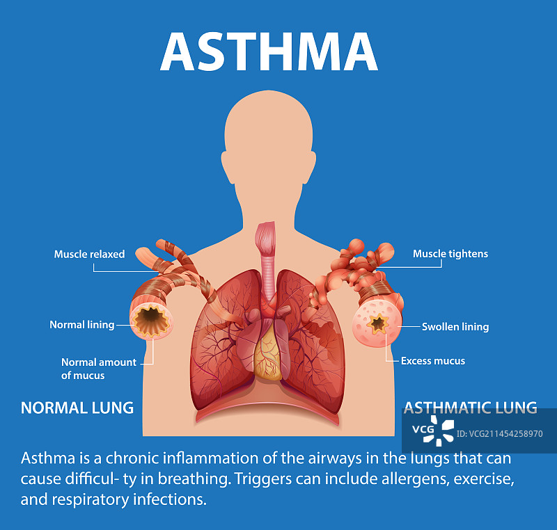 正常肺与哮喘肺的医学对比图片素材