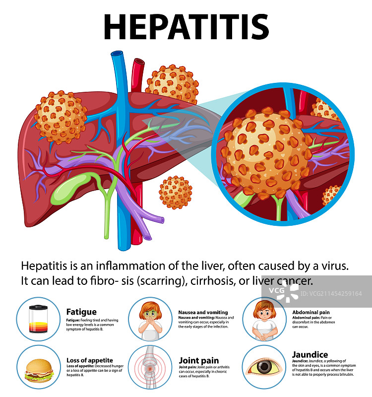人体解剖肝脏与肝炎症状图片素材
