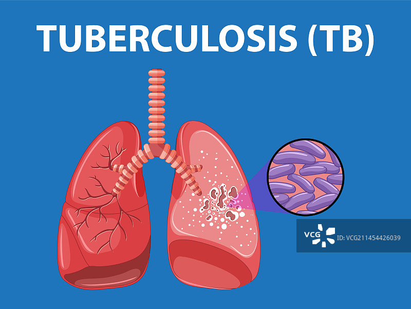 肺结核信息图：人体肺部解剖图片素材