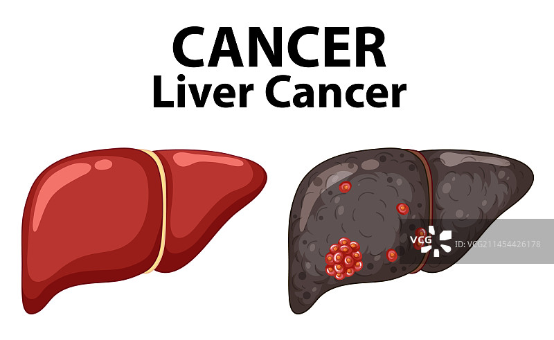 健康肝细胞与癌变肝细胞生长对比图片素材