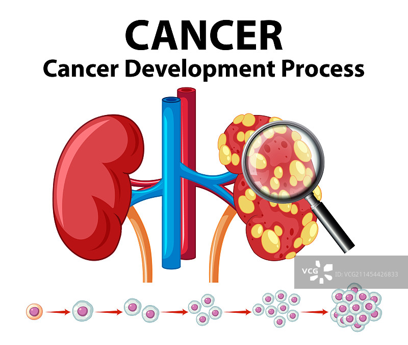 人类肾脏癌症发展过程图片素材