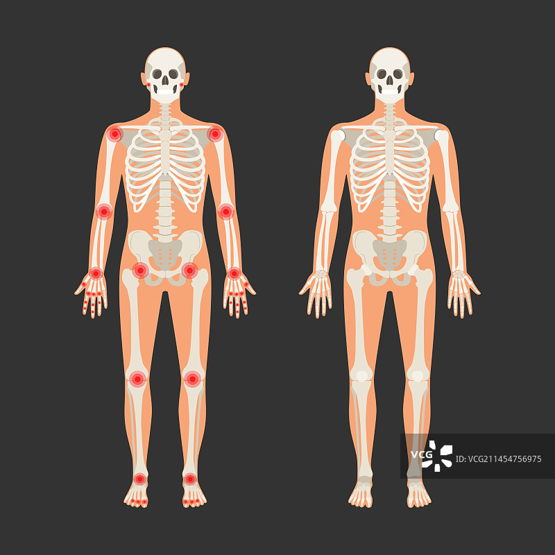 类风湿性关节炎疼痛点的人体骨骼图片素材