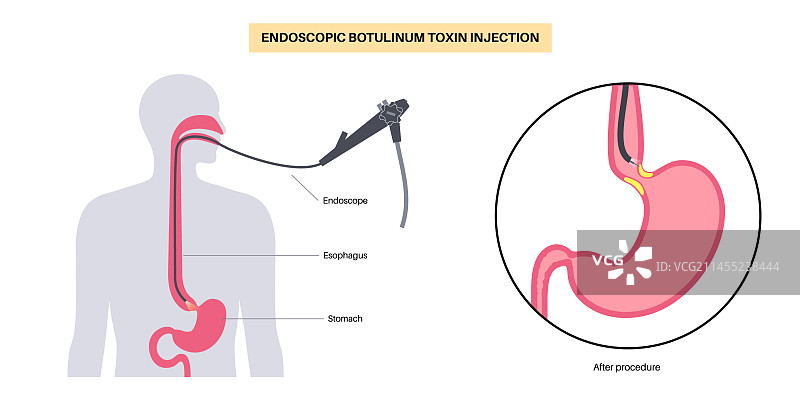 食道肉毒杆菌毒素注射图片素材