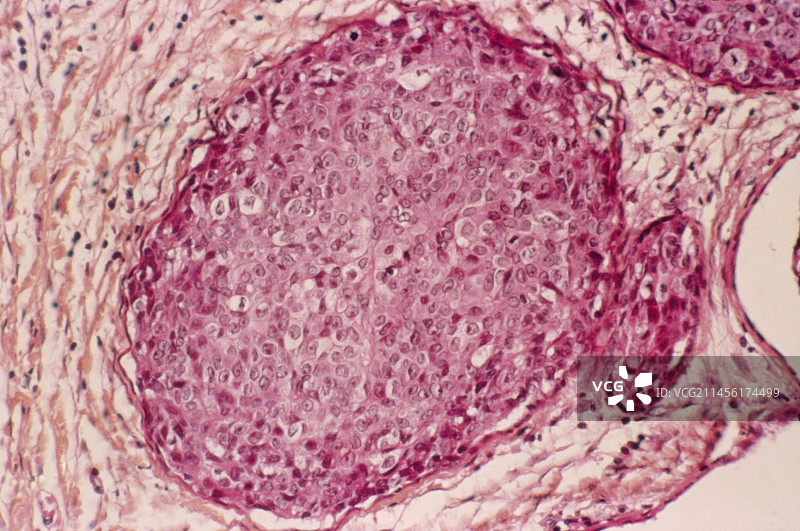乳腺癌图片素材