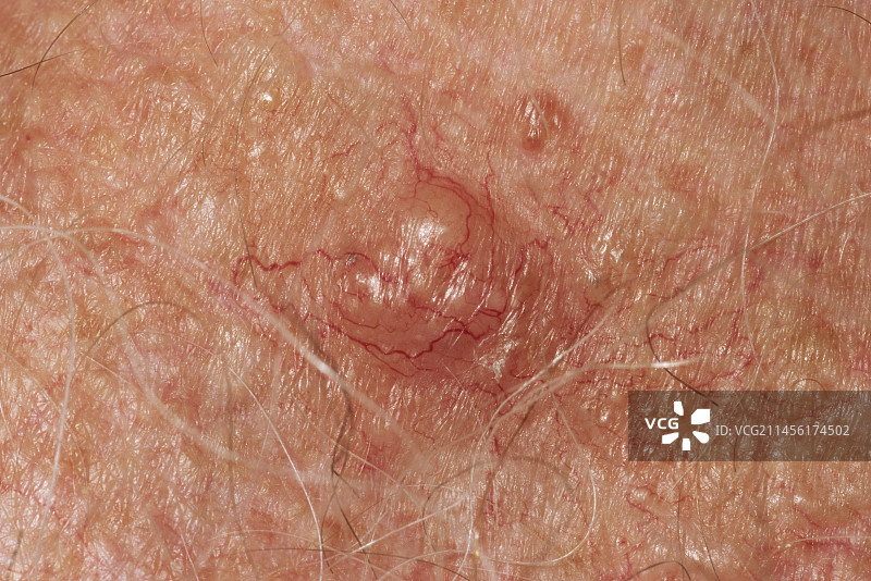 皮肤癌图片素材