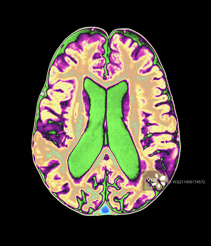 彩色有机磷脑损伤MRI扫描图片素材