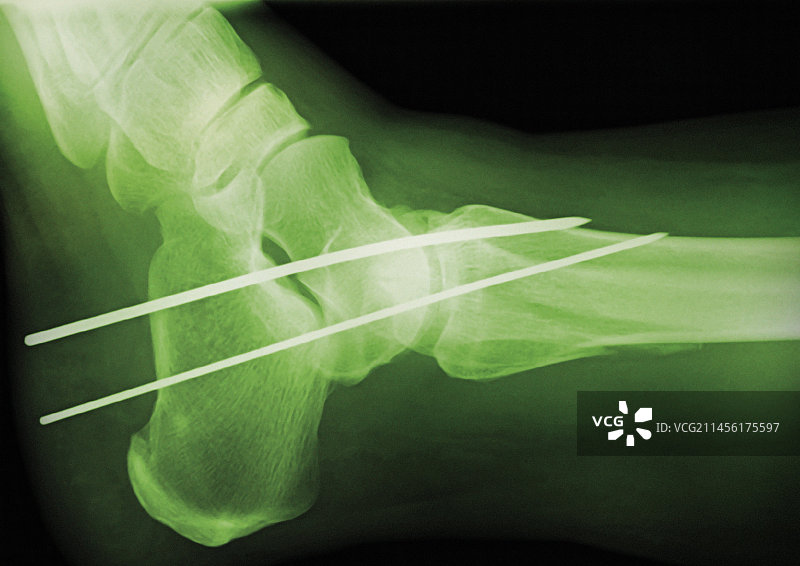 临时踝关节固定X光片图片素材