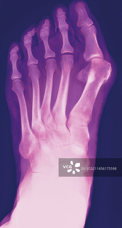 拇囊炎X光片图片素材