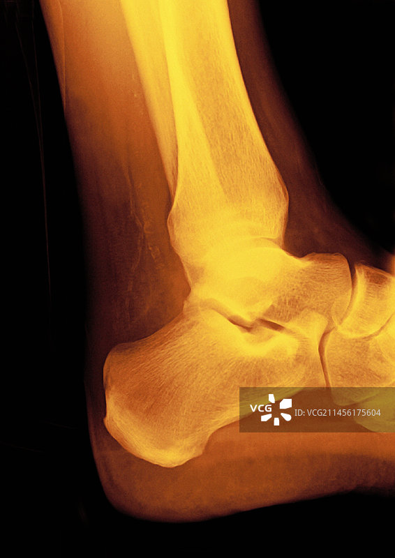 正常踝关节X光片图片素材