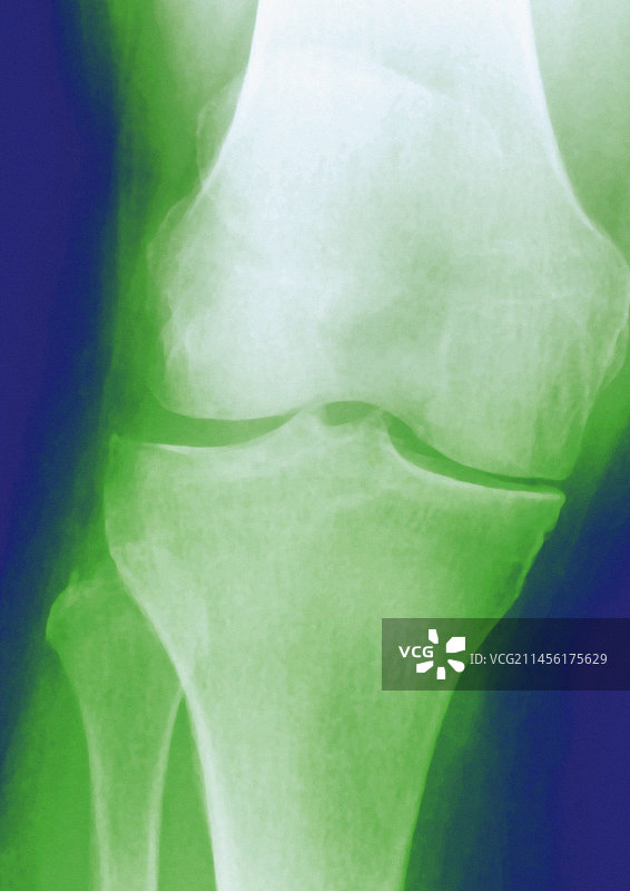 膝关节骨关节炎X光片图片素材