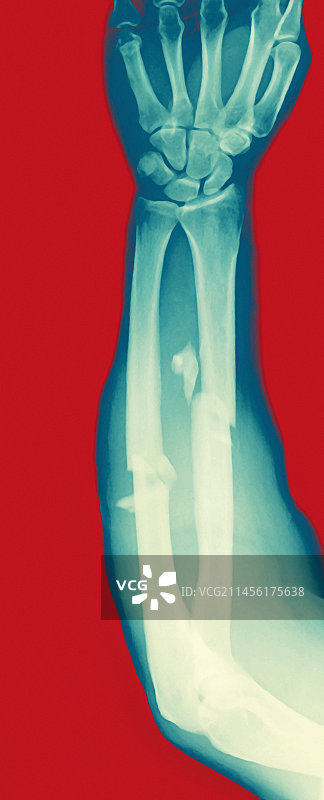手臂骨折X光片图片素材