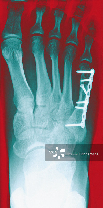 足骨骨折内固定X光片图片素材