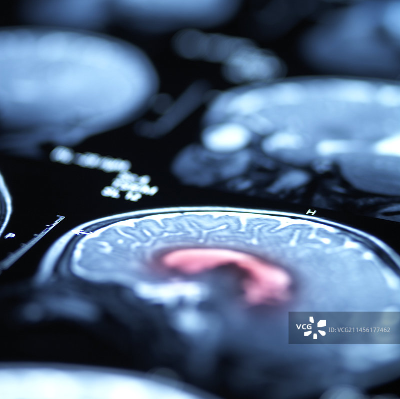 脑部扫描图片素材