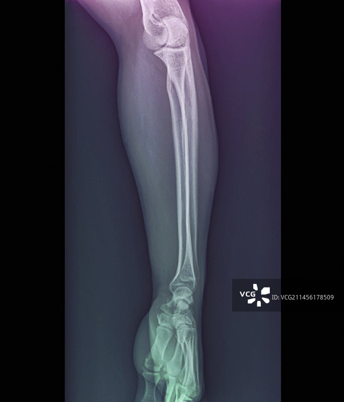 正常肘关节和腕关节X光片图片素材