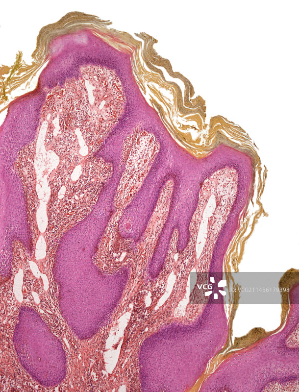 疣，光学显微镜照片图片素材