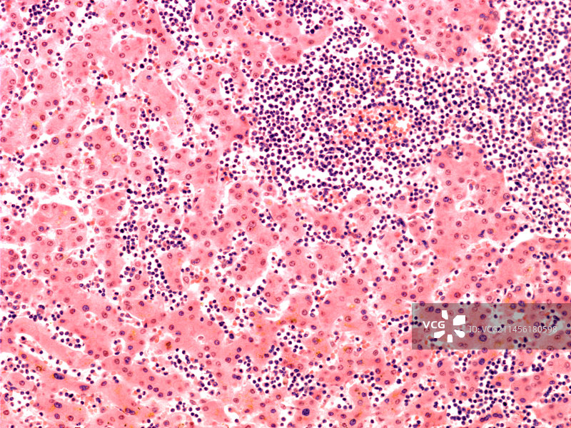 淋巴细胞白血病血细胞，光学显微照片图片素材