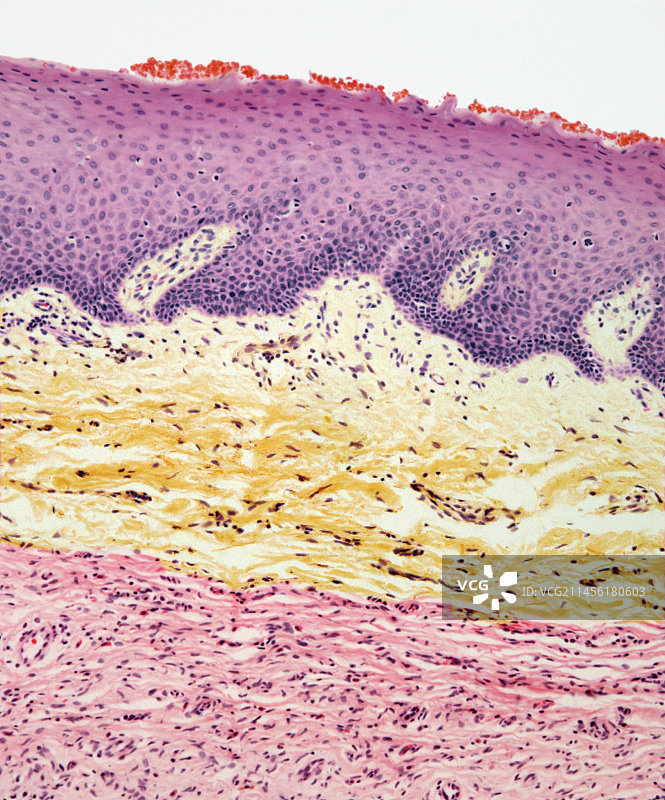 神经纤维瘤显微照片图片素材