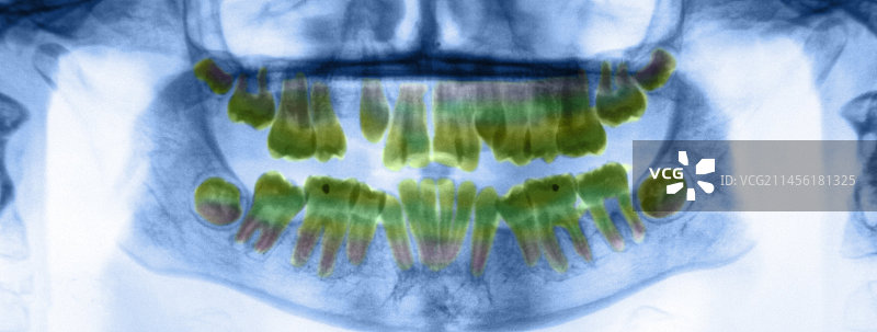 牙科X光片图片素材