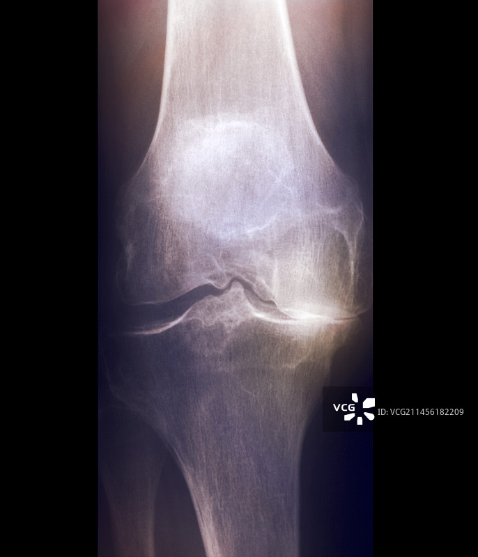 膝关节炎X光片图片素材