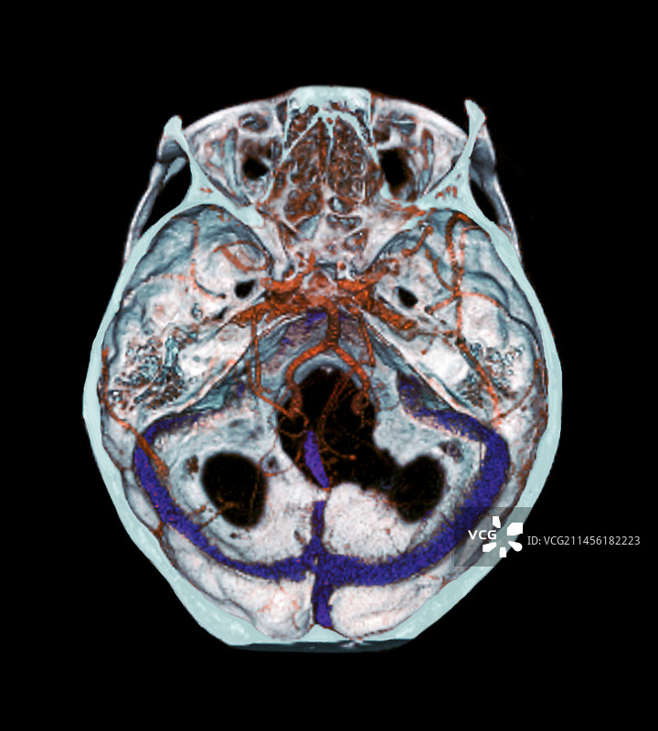 大脑动脉3D CT扫描图片素材