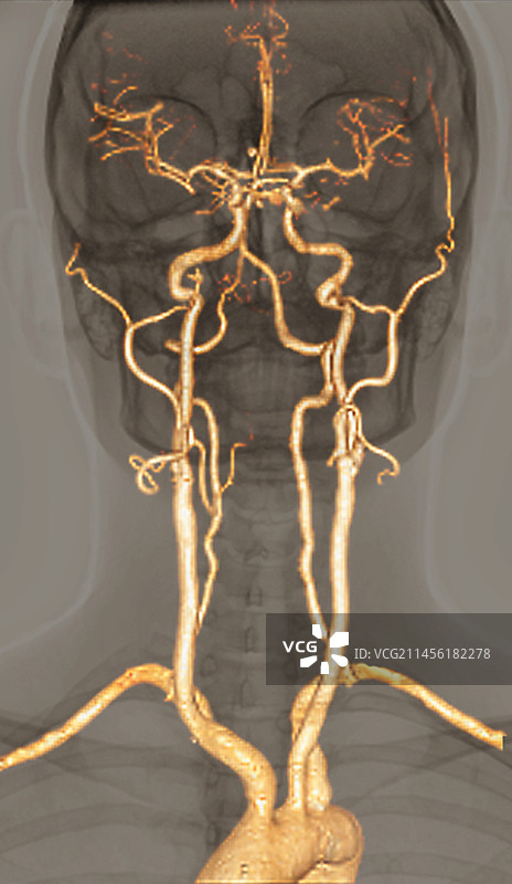正常的动脉血管3D CT扫描图片素材
