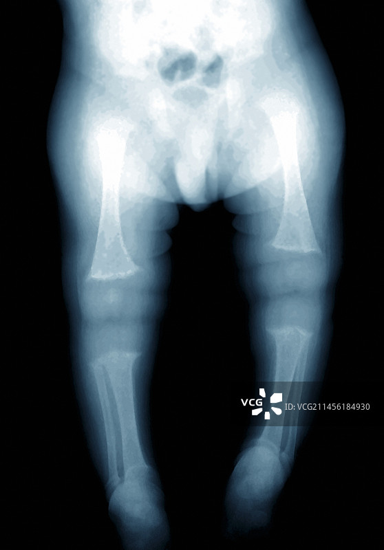 佝偻病X光片图片素材