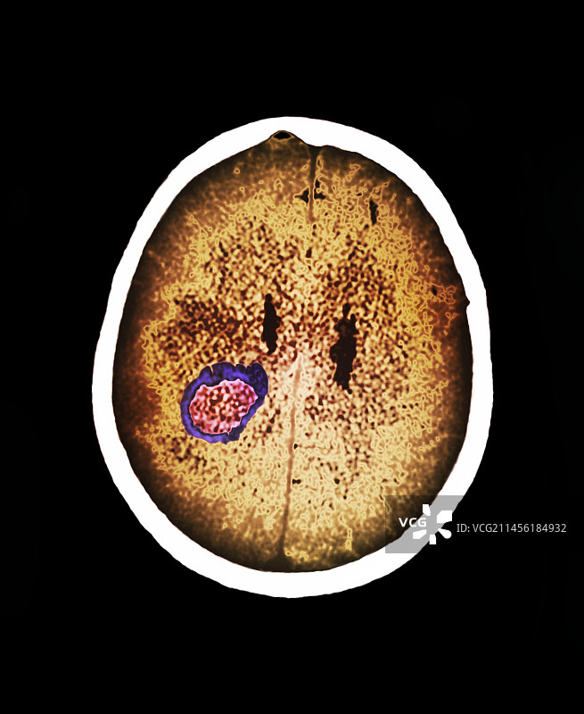 脑脓肿CT扫描图片素材