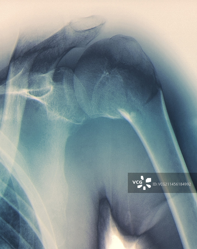 肩部X光片图片素材