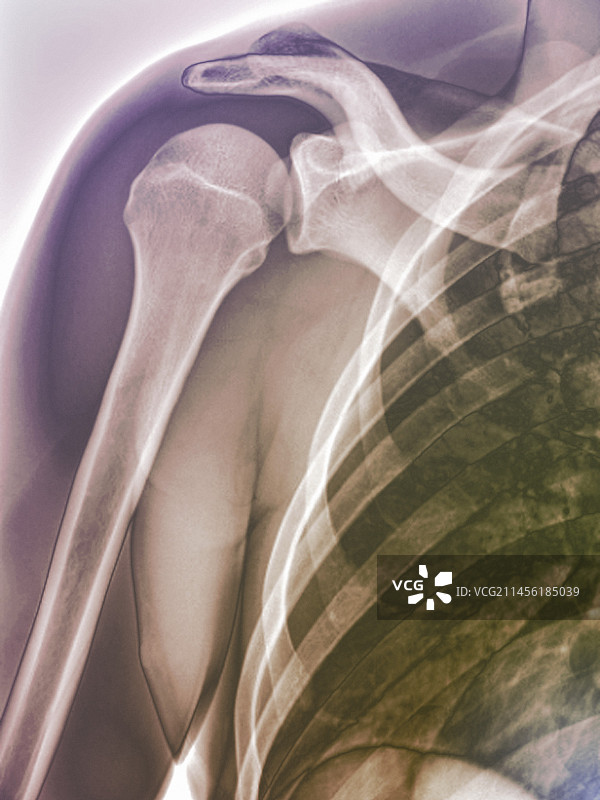 正常肩部X光片图片素材