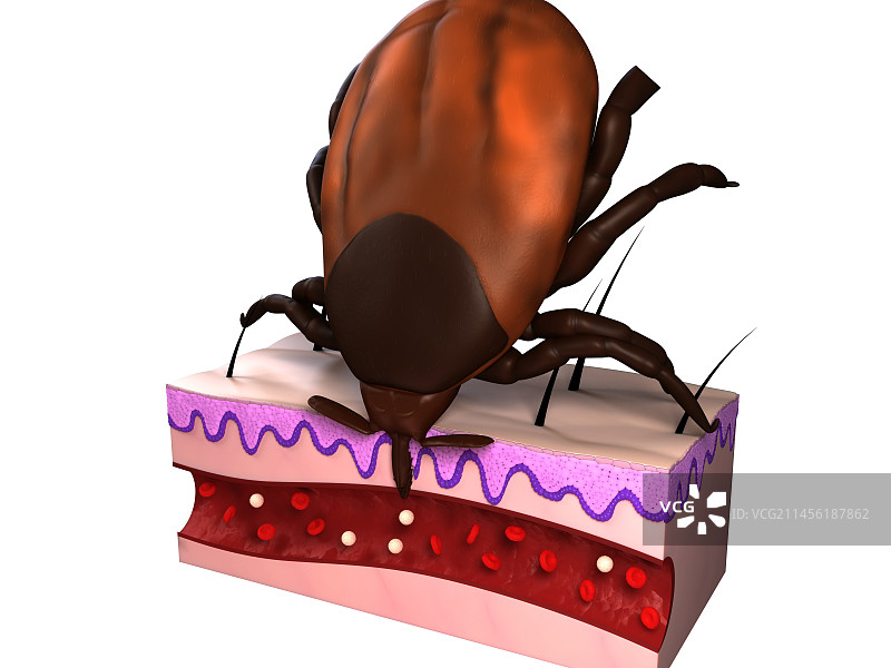 蜱虫叮咬，艺术作品图片素材